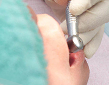 歯科医院で歯石除去する男性