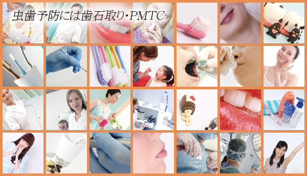【虫歯予防には歯石取り・PMTC】